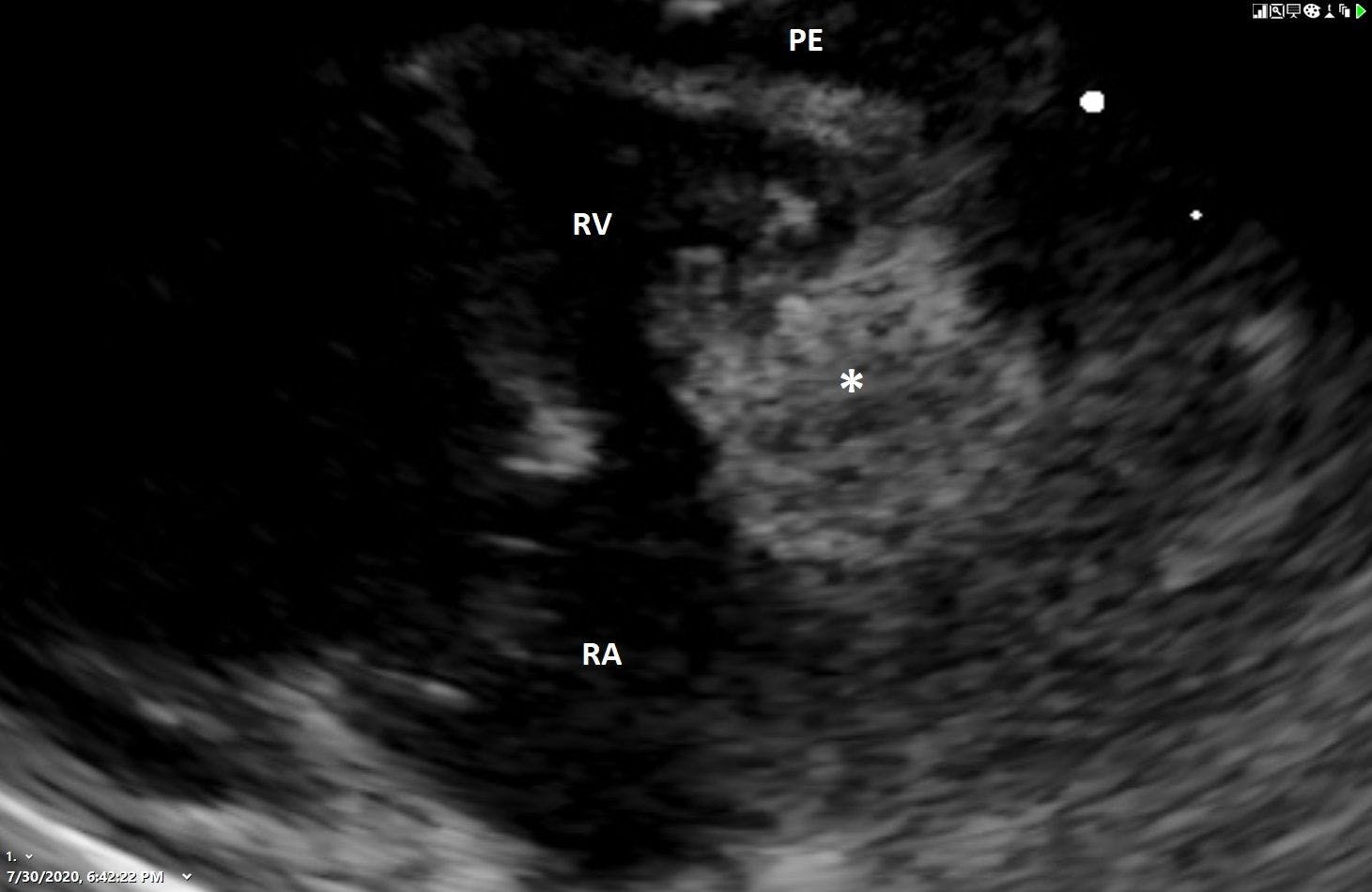 Figure 4. Left intercostal view of the right ventricle (RV) and atrium (RA) depicting the RV in the near field and the RA and atrial appendage in the far field. Trace pericardial effusion is visible as the anechoic stripe between the pericardium and RV. The asterisk indicates hyperechoic segmental thickening of the RV and atrial wall. The tentative diagnosis in this geriatric domestic shorthair cat was an extranodal lymphoma. Pericardial fluid analysis may have provided cytologic evidence of this tumor, but it was not attempted due to the scant volume.