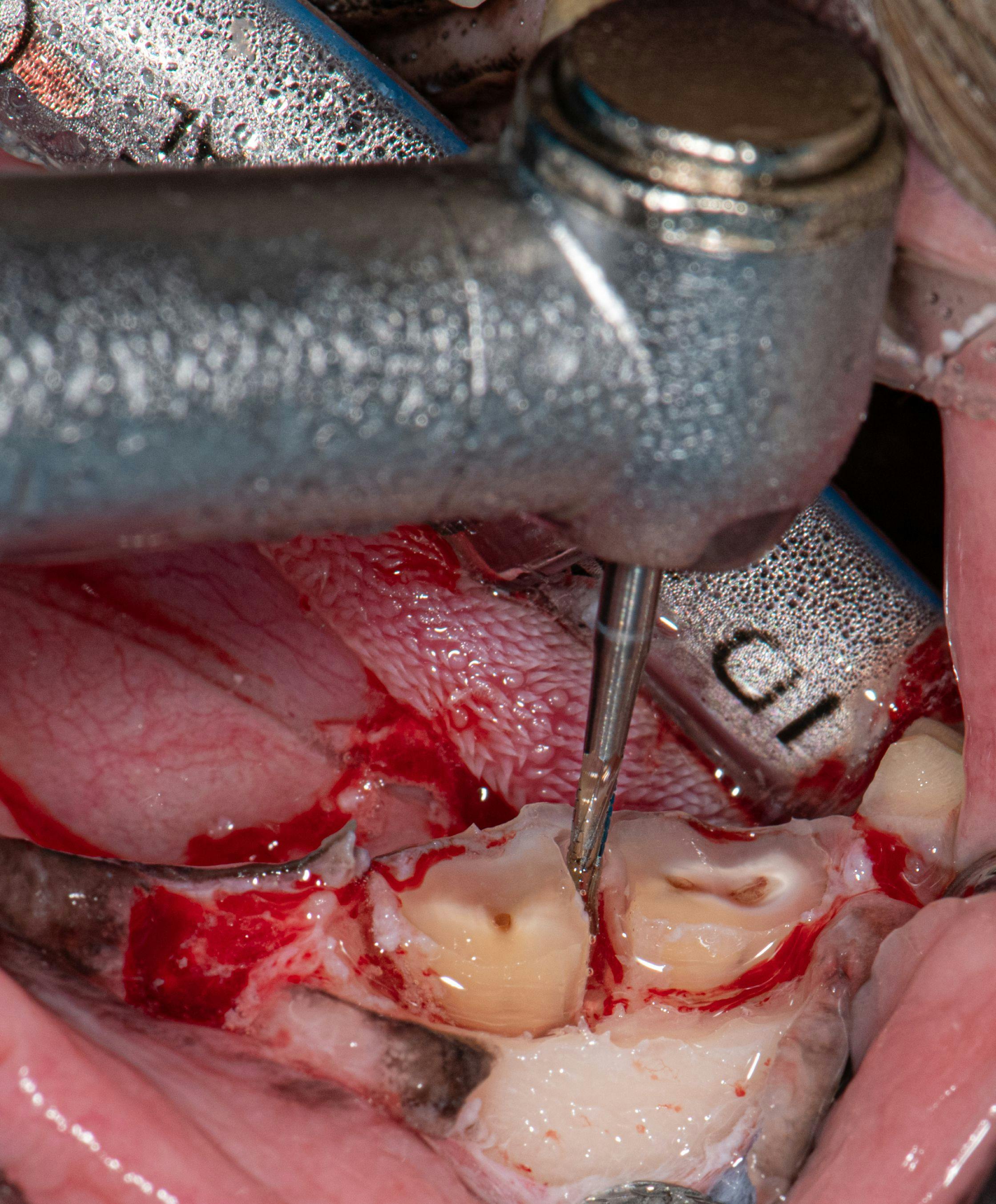Figure 10: A surgical bur is used to create a moat around the roots of the mandibular first molar to ease the insertion of the wing-tipped elevator blade.